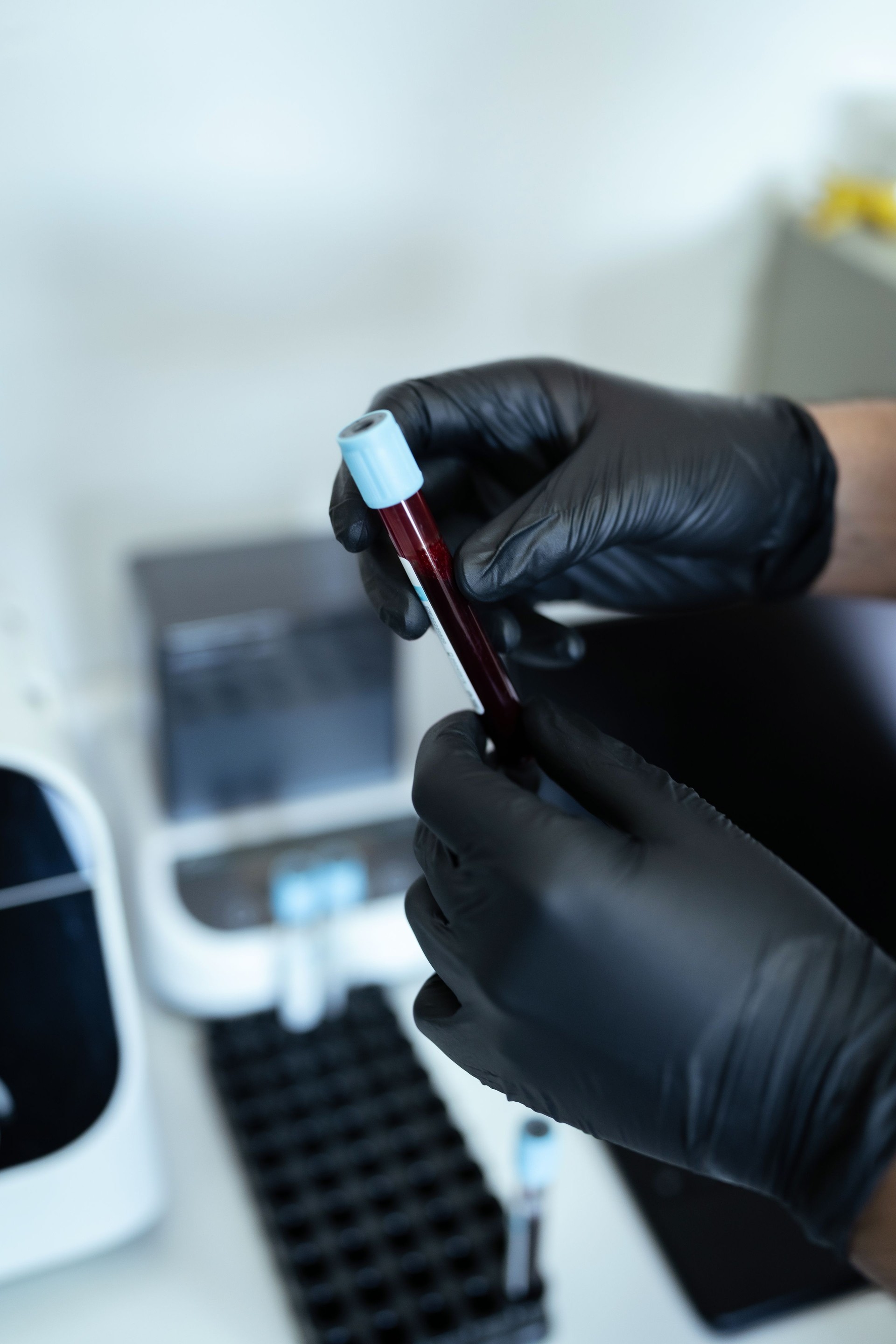 Wissenschaftler hält Reagenzglas mit Blutprobe für die PRP-Behandlung in der Hand